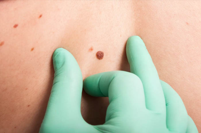Types of skin moles and how to know if they’re safe