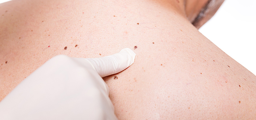 Skin Cancer Self-examinations: Understand Your Risks