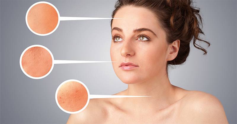 What Type of Acne Do You Have? Types of Acne Explained